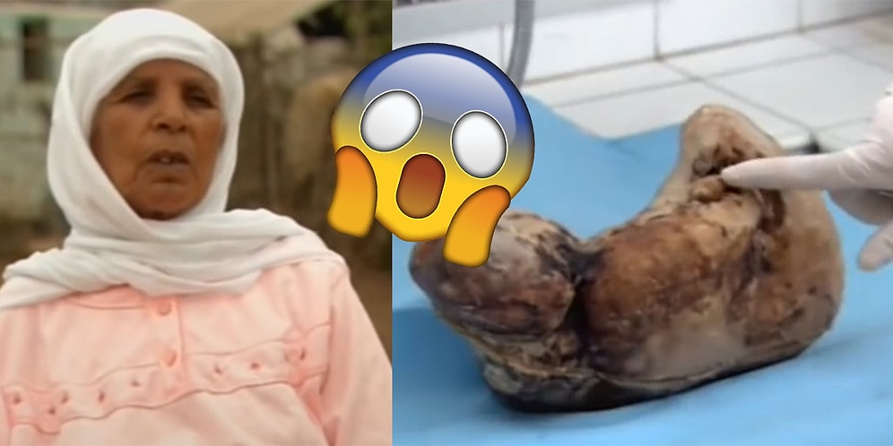 Woman Pregnant For 46 YEARS Gives Birth To ‘Stone Baby’!